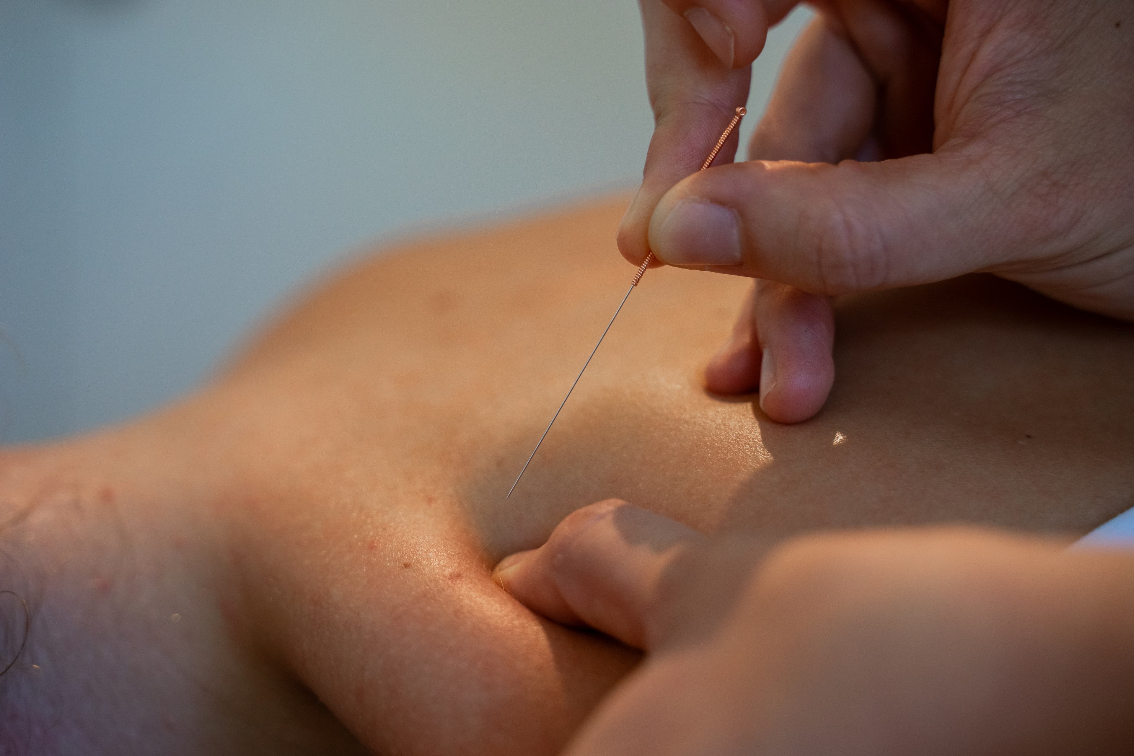 Close-up van een dunne dry needling-naald die in een triggerpoint van de rugspier wordt geplaatst